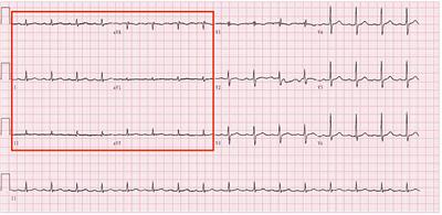 A case report and review of literature: Tuberculous pericarditis with pericardial effusion as the only clinical manifestation